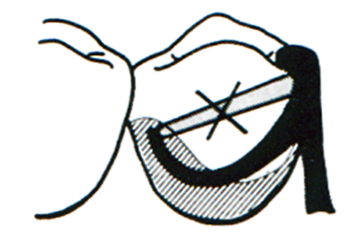 Fig. 1. El remodelado dentario permite ubicar el brazo retentivo en una posición más gingival