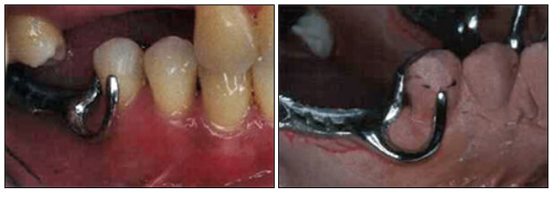 Fig.2. Con la utilización del retenedor R.P.I. en casos del maxilar inferior, se logra una mejor estética.