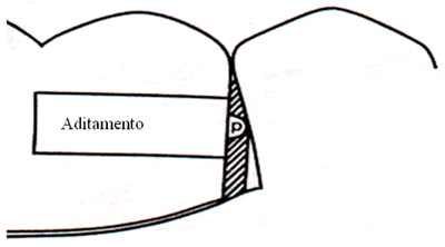 Fig. 7. Ubicación del aditamento del resorte cargado en un émbolo en relación con el área retentiva del diente (Tomado de Wright 1984)