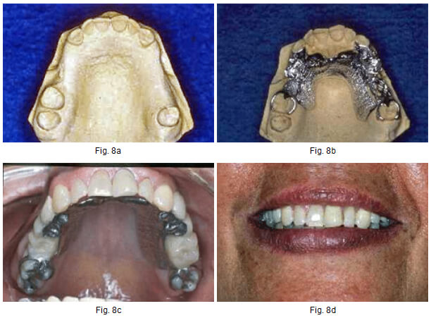 Fig. 8. Caso Clínico. Tratamiento con p.p.r. con Eje rotacional de inserción.