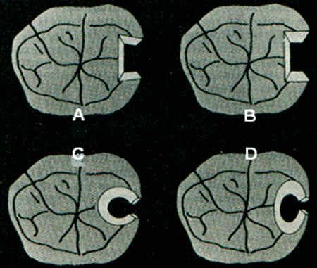 Fig. 10. Cuatro formas oclusales de descansos de semiprecisiòn. A. muecas, B. rectangular, C. circular y D. cola de milano. (Tomado de Zinner, 1985)
