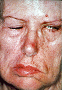 FIGURA 1: Aspecto clínico de la parálisis facial