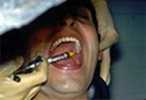 FIGURA 2: Parálisis facial transitoria