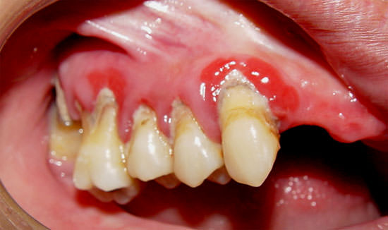 Figura 2 Aspecto gingival en el paciente diabético.