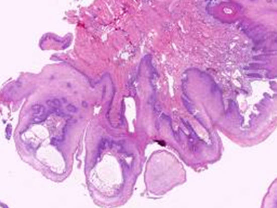 Figura 2 Mucosa escamosa, con engrosamiento del epitelio, sin desorden madurativo ni atipia y con marcada papilomatosis (HE, 10x).