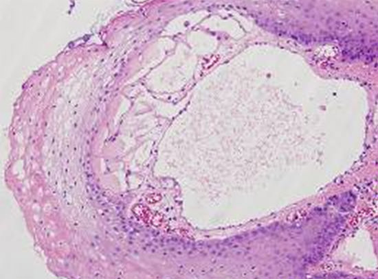 Figura 3 La submucosa constitutiva del eje de las papilas mostraba numerosos conductos vasculares de endotelio aplanado y muy ectásicos, con contenido proteináceo. En algunas zonas se encontraban en contacto directo con el epitelio (HE, 50x).