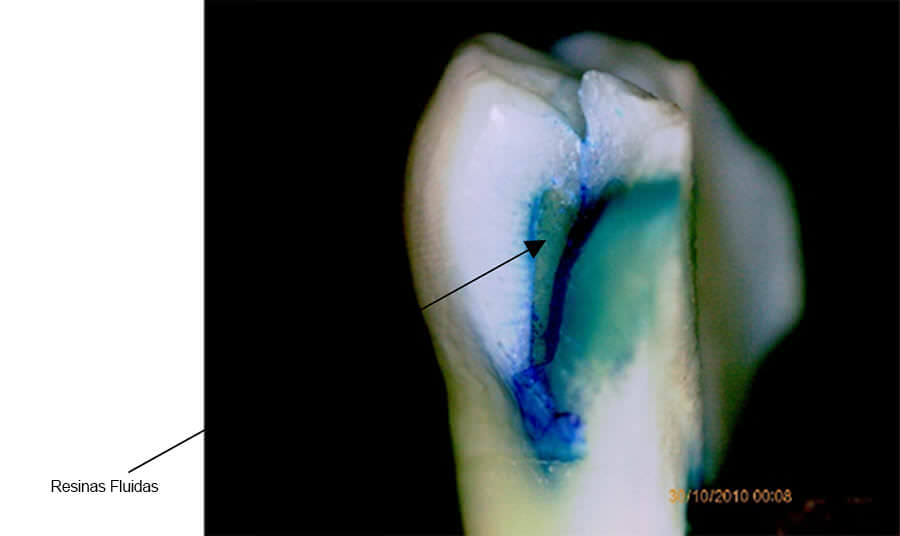 Figura 5 Microfiltración Marginal de las Resinas Fluidas, Grado 3. Estereomicroscopia, CIMBUC, Universidad de Carabobo. Fuente: Toledo,Gallegos, López .(2016)