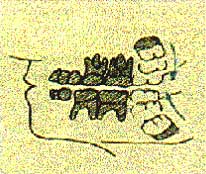 Fig. 2 Dirección Mesio-Distal