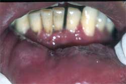 Fig. 2 Mucosa labio inferior