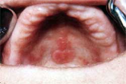 Figura Nº 1: Estomatitis protésica