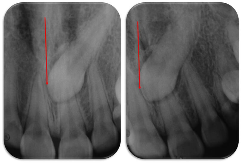 Figura 3 (radiografías periapicales Ortoradial y Distoradial) Figura 3. Se aprecia desplazamiento del canino en sentido contrario al desplazamiento distorradial. Se concluye posición palatina de la corona del 2.3)