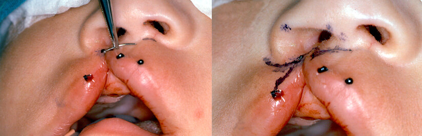 Foto N° 3 y foto N°4: Muestran los trazados de la líneas para el diseño de los colgajos.