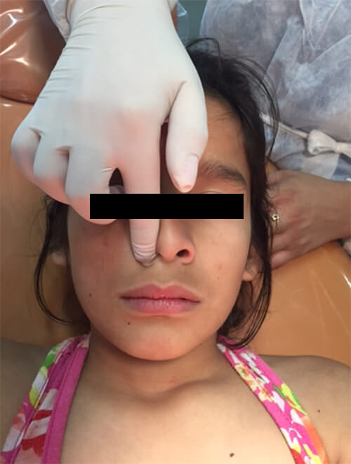 Figura 4: Prueba de Rosenthal ocluyendo narina izquierda 