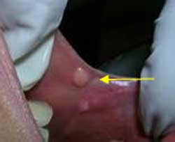 Fibroma traumático