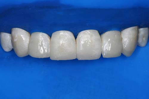 Figura 6 Restauraciones inmediatamente después de realizada la técnica estratificada. Los colores utilizados fueron: en los incisivos centrales y laterales, A2D, para simular la opacidad de la dentina; A2E, para la conformación de las superficies palatina y vestibular. En los caninos, fueron utilizados los colores A2D, para dentina, y A3D, para simular el esmalte de estos dientes.