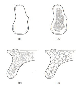 Fig. 1 Descripción macroscópica de la densidad ósea maxilar según Misch.