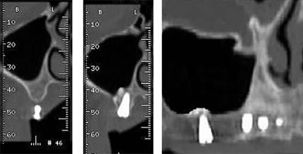 Fig 13 Izquierda: Proyección frontal preoperatorio región del 16 con referencia en gutapercha. Centro, la misma proyección 6 meses después de colocar el implante. Derecha: proyección sagital. En el postoperatorio se observa una cúpula de tejido óseo alrededor de la región apical del implante.
