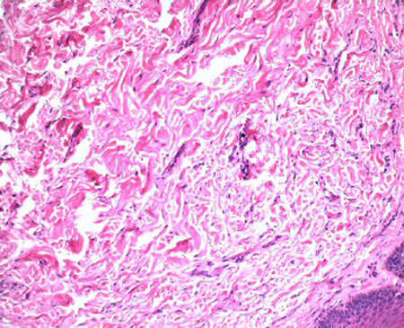 Fig 2 Corte histológico mostrando gran cantidad de fibras colágenas y fibroblastos asociados a un intenso infiltrado inflamatorio crónico.