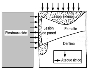 Figura 1 Imagen esquemática que representa la lesión externa y la lesión de pared de una caries secundaria. Tomado de Kidd, 1990.