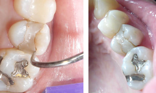 Foto 1 y 2 Caso clínico de un paciente de pregrado de la Facultad de Odontología de la Universidad Central de Venezuela, donde se aprecia una restauración de resina compuesta defectuosa (brecha marginal) en segundo premolar derecho, Foto 1 (izquierda): se aprecia la punta de un explorador romo que penetra a nivel de la interfase diente-material restaurador, evidenciando la presencia de una brecha marginal amplia. Foto 2 (derecha): se observa la extensión de la brecha marginal hacia la superficie proximal distal del diente.