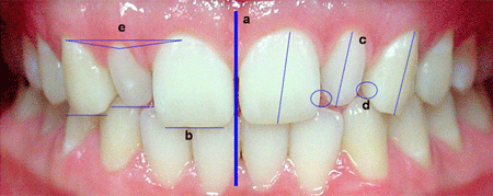 Figura 2. a) Línea media, b) bordes incisales, c) ejes dentarios, d) puntos de contacto, e) márgenes gingivales.