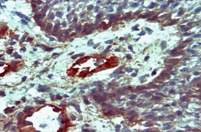 Fig. Nº 3 Expresión de la Molécula de Adhesión ICAM-1 en tejido de Estomatitis Aftosa Recurrente 40X