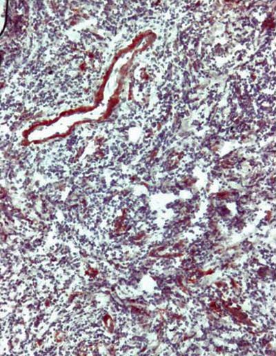 Fig. N° 4 Expresión de la Molécula de Adhesión VCAM-1 en tejido de Estomatitis Aftosa Recurrente 40X