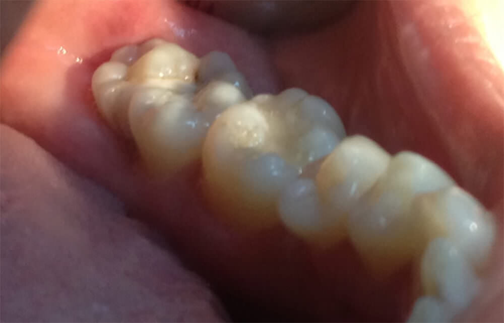 Fig. 1Aspecto Clínico Intrabucal (Fusión de tercer inferior y cuarto molar supernumerario)  Fig. Appearance clinical intraoral (Fusion of third bottom and fourth molar supernumerary) Fuente: Caso clínico 