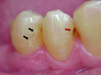 Figura 1: fotografía de lesión de mancha blanca (flecha negra) en primer premolar inferior izquierdo y lesión de caries cavitada (flecha roja) en canino inferior izquierdo.