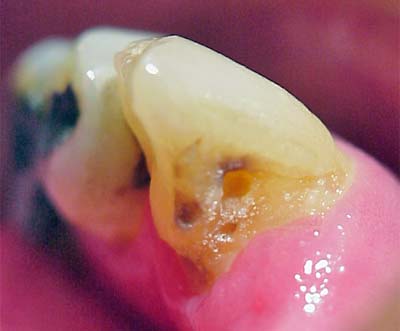 Figura 2: fotografía de lesión de caries cavitada con dentina expuesta al medio bucal en canino inferior derecho.
