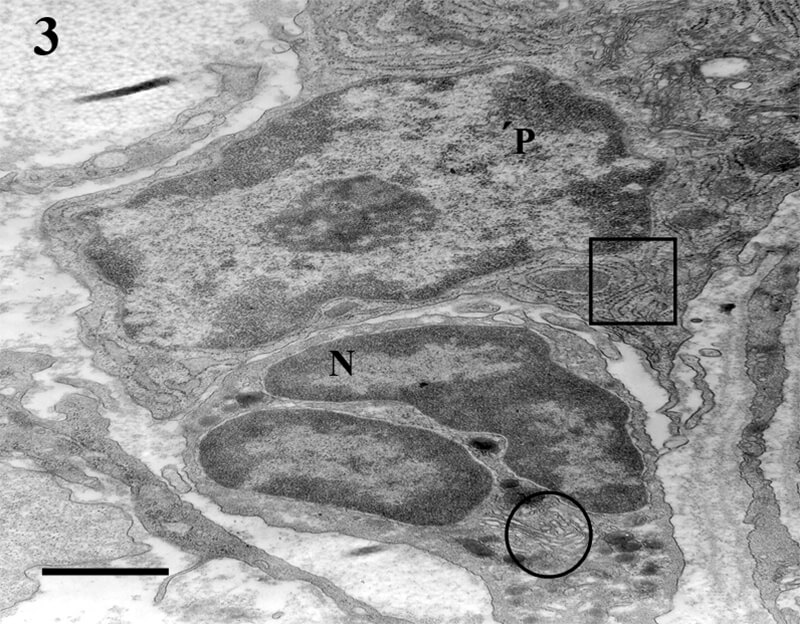 Fig 3. CA. P: plasmocito. Cuadrado: RER. N: neutrófilo. Círculo: Golgi. Bar=0.5μm