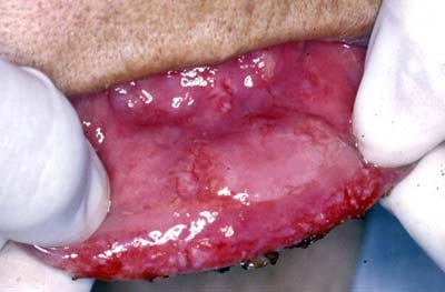 FIGURA 2 - Úlcera en mucosa labial inferior, recubierto por una membrana esblanquizada y con sangramiento a la manipulación.