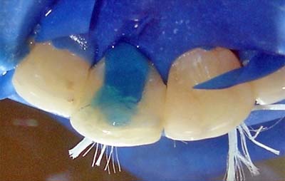 Fig.10 - Condicionados con ácidos fosfórico en gel a 37%