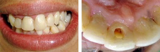 Fig. 1 - La pieza dentaria 11