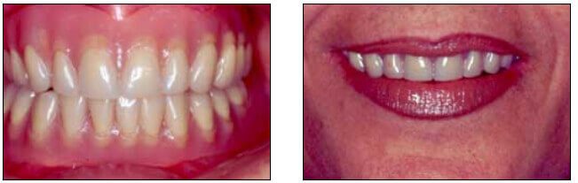 Figura 5 - f Sobredentadura total superior y dentadura total inferior en boca. Resultado final.