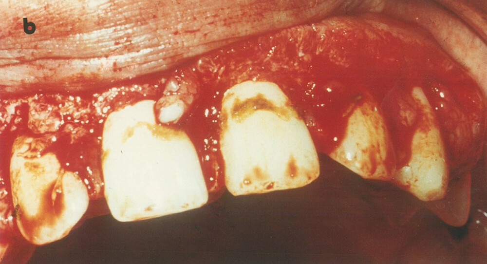 1-b.- Realización de la gingivoplastía del sector anterior superior, observándose la presencia de tártaro.