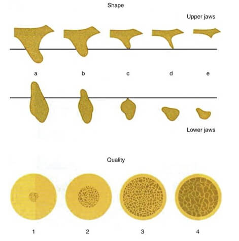 FIGURA 1 Clasificación de la forma residual de los maxilares y la calidad del hueso de los maxilares, según Lekholm y Zarb-1985-. (De Lindhe, K. Karring,T. ‎ Lang, L. Periodontología clínica e implantología odontológica. 5ta ed. Madrid: Ed Medica Panamericana; 2009.p. 53