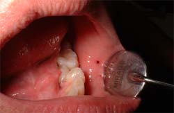 Figura 4: Injuria Física por traumatismo de mordedura en la zona de la mucosa del labio inferior en paciente adulto con mala posición dentaria que asiste a consulta