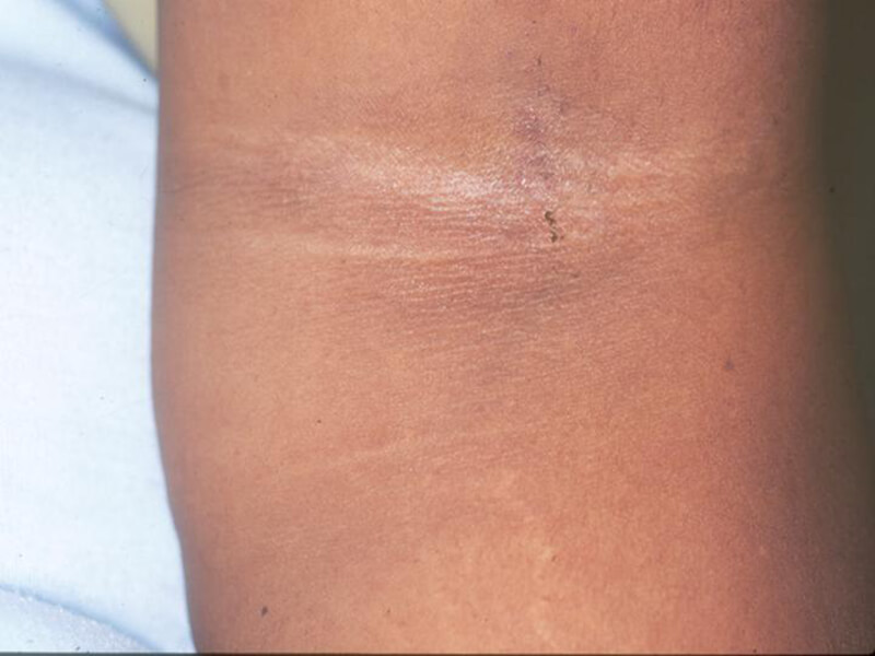 Figura 1: Mácula hipopigmentada en pliegue del antebrazo