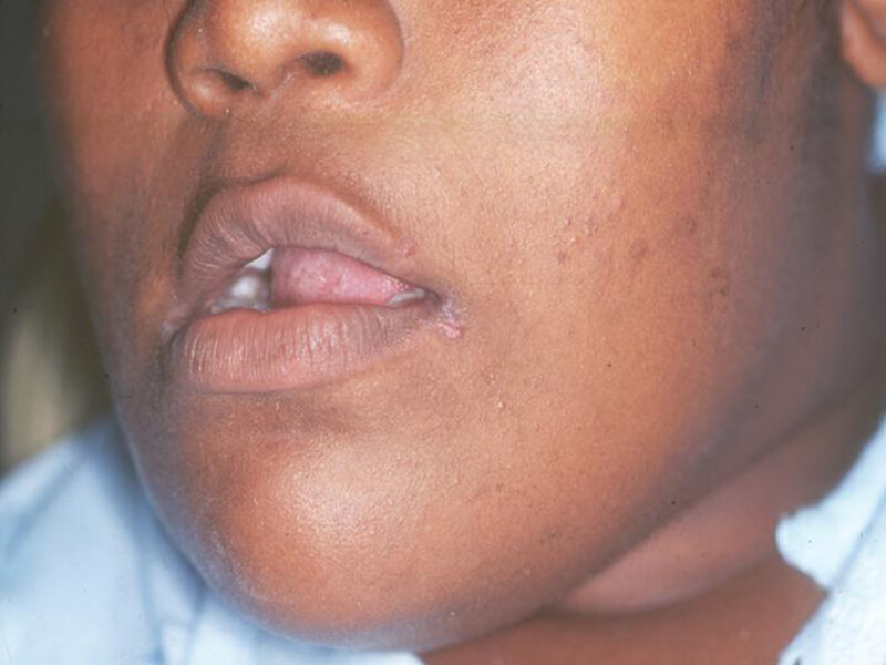 Figura 3: Queilitis Angular