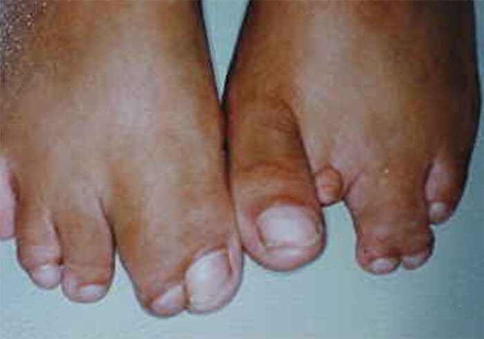 Figura 4: Ambos Pies con Sindactìlia y ectrodactilia.