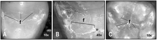 Fig. 2 Imágenes de las superficies oclusales capturadas con video lupa y luz incidente: A. restauración realizada en un premolar superior que muestra buena adaptación marginal (bajo porcentaje de fallas); B. detalle de una amplia zona de desadaptación marginal presente un premolar superior; C. zonas de desadaptación marginal mostradas en un molar superior con márgenes configurados en bisel cóncavo.