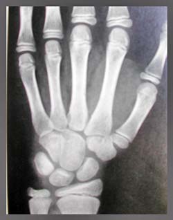 Fig 1: Radiografía carpal