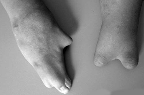 Figura 1 - Examen clínico general: displasia de miembros superiores con presencia de braquidactilia y sindactilia.