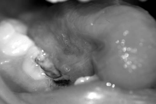 Figura 5 - Examen clínico intrabucal: implantación heterotrópica de la lengua.