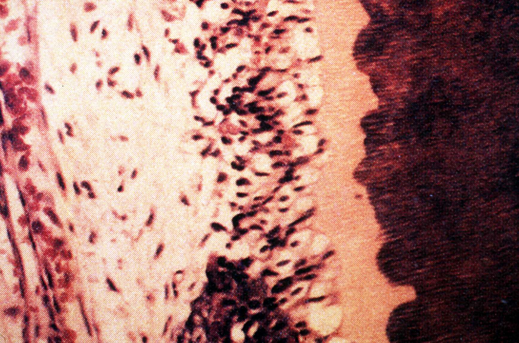 Fig. 1- Efecto del Laser de Er:YAG en el tejido pulpar. Note la apariencia normal de la capa odontoblástica en el área tratada. Fotomicrografía X 400. Tinción con Hematoxilina y Eosina. (Tomado de Zakariasen K. L.)