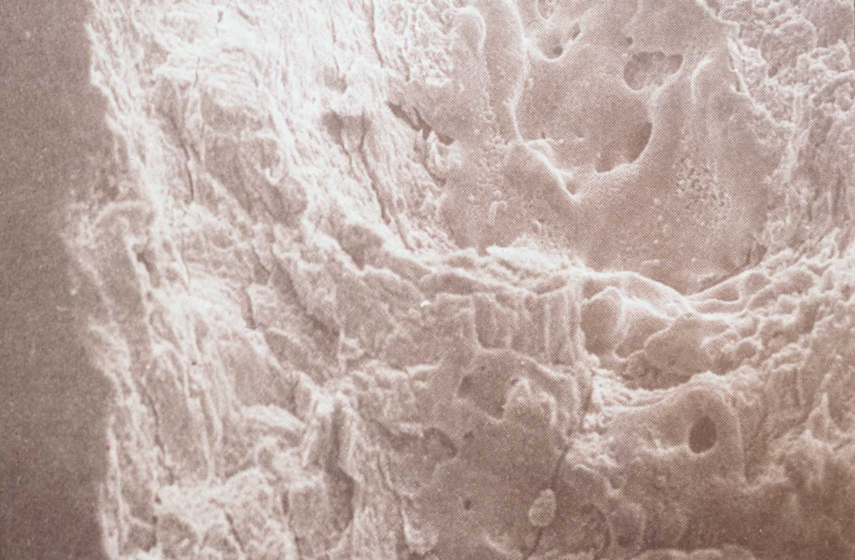 Fig. 4.- Esmalte fundido con bordes redondeados con un Laser de Er:YAG en un molar seco. Magnificación X 205. (Tomado de Burkes E. J. Jr., Hoke J., Gomes E. and Wolbarsht M.)