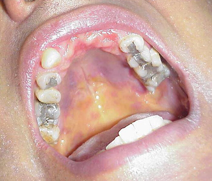 Foto 1: Sarcoma de Kaposi y hepatitis