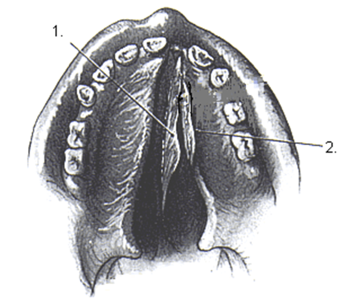 Figura N°2. 1. Colgajo de mucosa del Vomer, 2. Colgajo de mucosa palatina Fuente: Tratado de Cirugía Bucal de G. Kruger