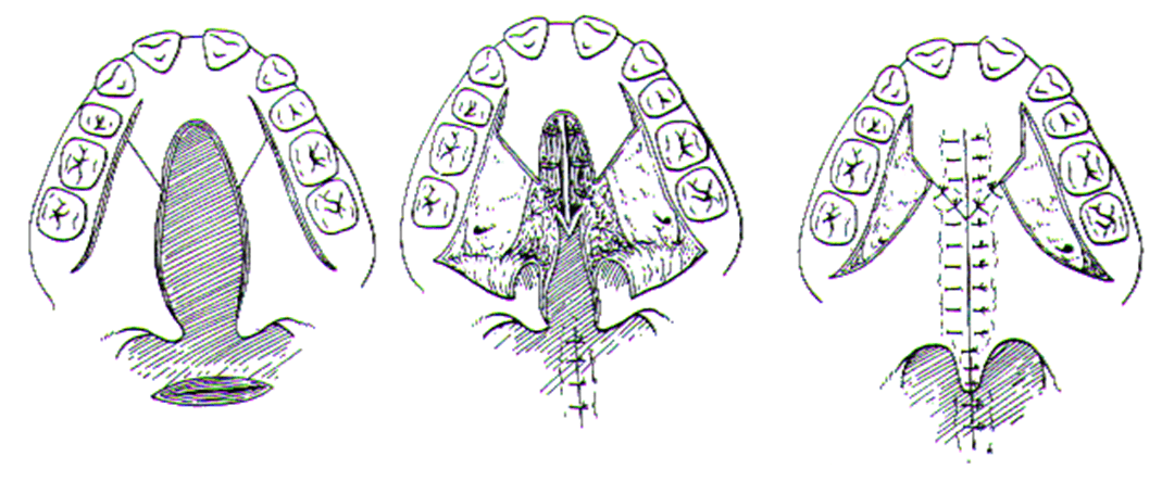 Figura N°3 Fuente: Cirugía Bucal de H. Archer